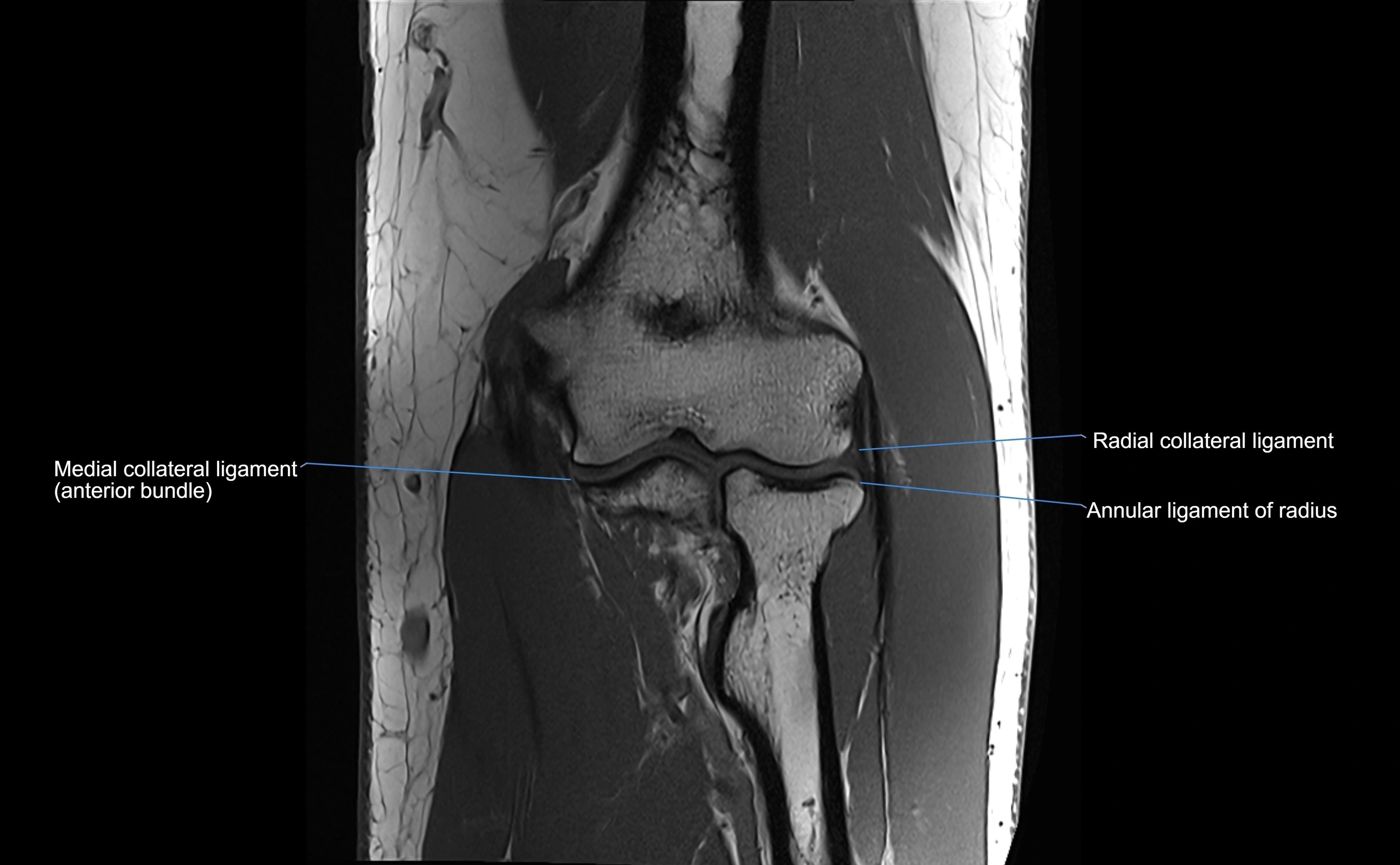 MRI elbow ligaments coronal cross sectional anatomy 3T  radiology  image-img-07001-00019.webp